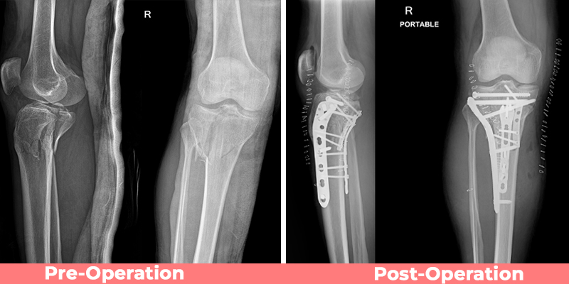 Complex Proximal Tibia Fracture