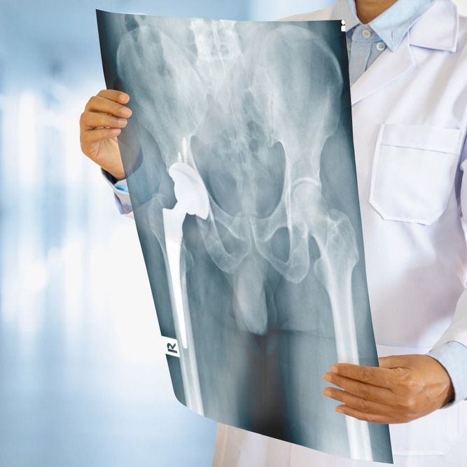 Joint Replacement (Knee/Hip)