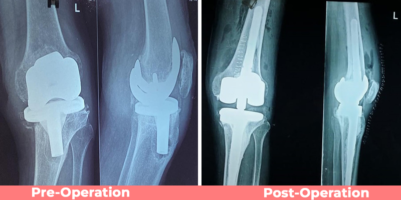 Revision Knee Replacement Surgery