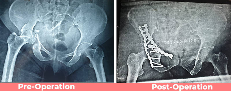 Pelvi – Acetabular case