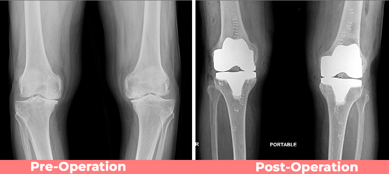 SUCCESSFUL ROBOTIC KNEE REPLACEMENT SURGERY