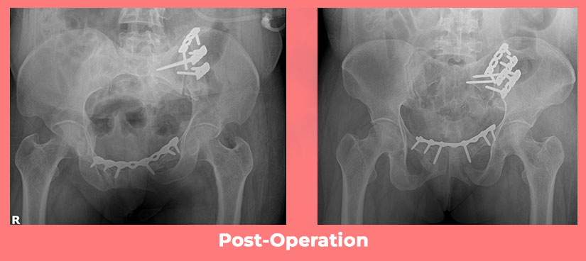 Complex Pelvic -Acetabular Injury