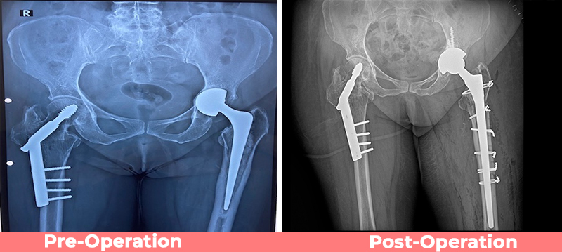 Revision Complex Total Hip Replacement