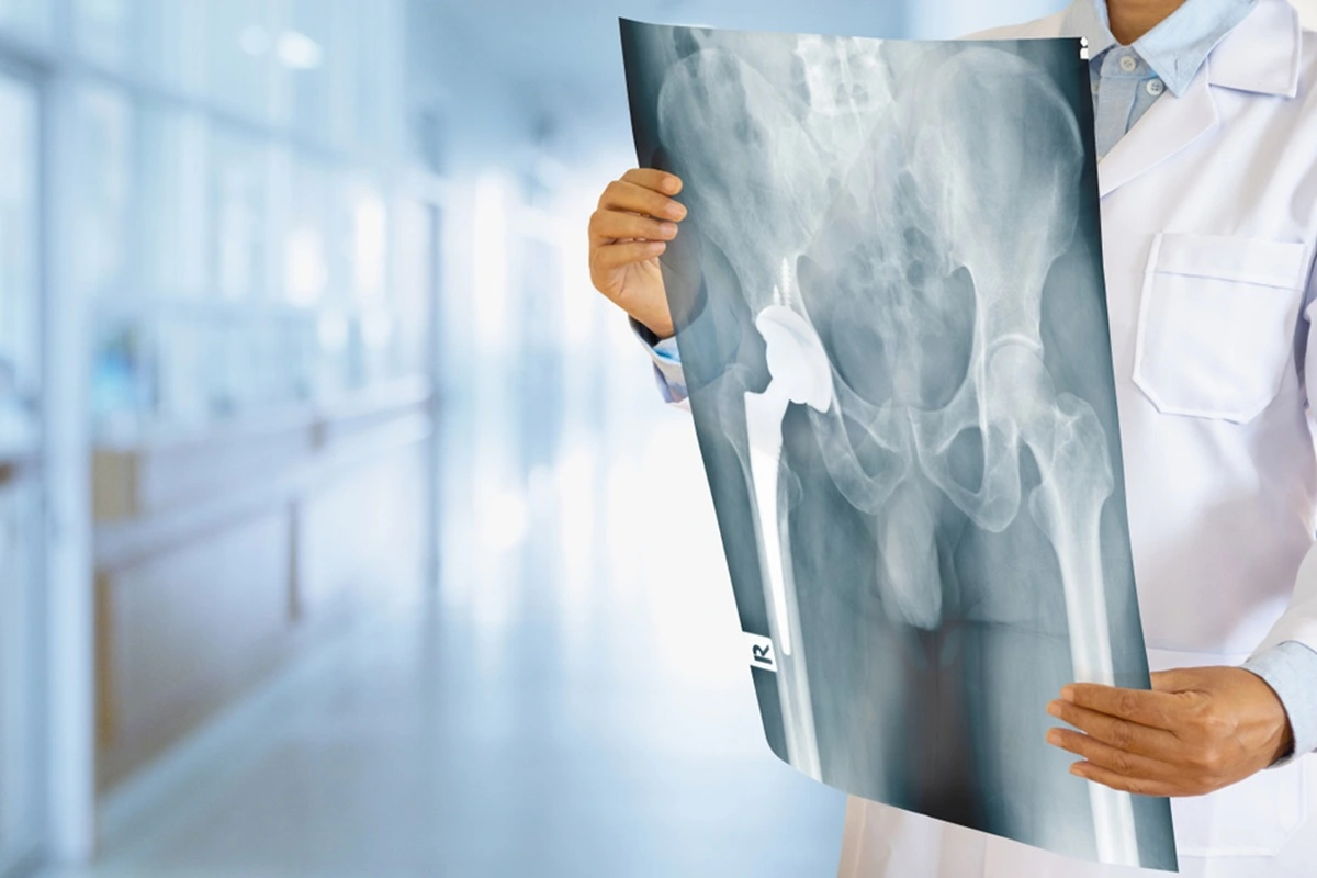 What is Osteoarthritis?