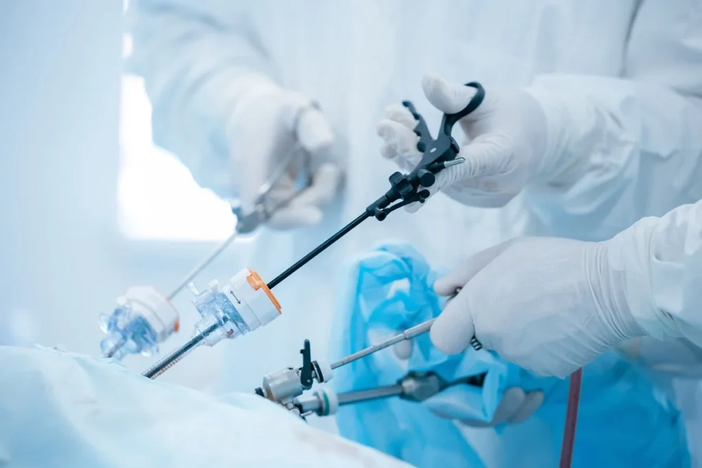 Laparoscopic Surgery Gallbladder Removal