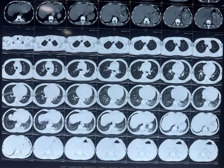 Invasive Fungal Lung Disease in an Immunocompromised Host